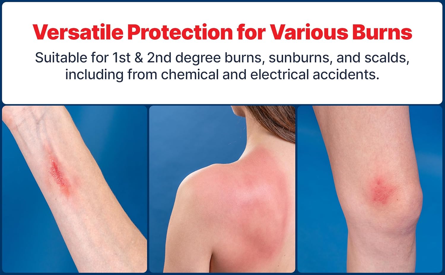 BurnFix Hydrogel Burn Spray – 120 ml Instant Cooling Relief for 1st & 2nd Degree Burns,